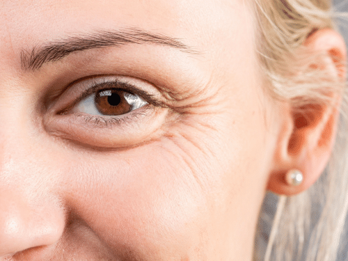 Botox® for Crow’s Feet: A Simple Way to Refresh Your Appearance